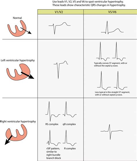 lv strain ecg|lvh signs on ecg.